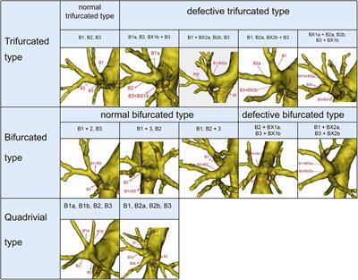 What is the correlation between the defective and splitting posterior segmental bronchus and recurrent artery crossing intersegmental planes in the right upper lobe?